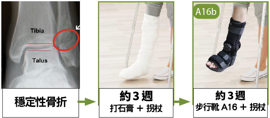 穩定性足踝骨折石膏與短身步行靴復康流程